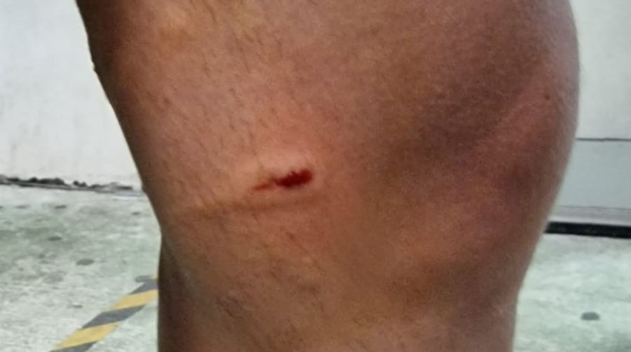 Referto medico del Pronto soccorso: «morso da lupo» 2 morso lupo 1